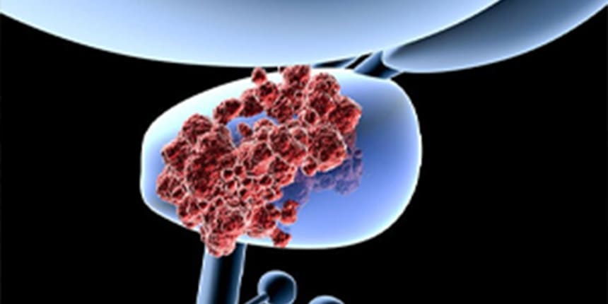 Cáncer de próstata