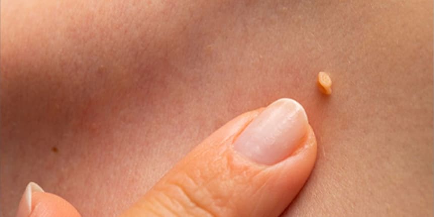 Eliminación de verrugas genitales